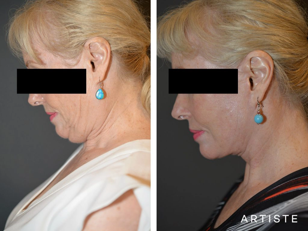 64 Years Old: High SMAS Face and Neck Lift, Structural Fat Grafting, Peri-Oral Dermabrasion, Chemical Peel