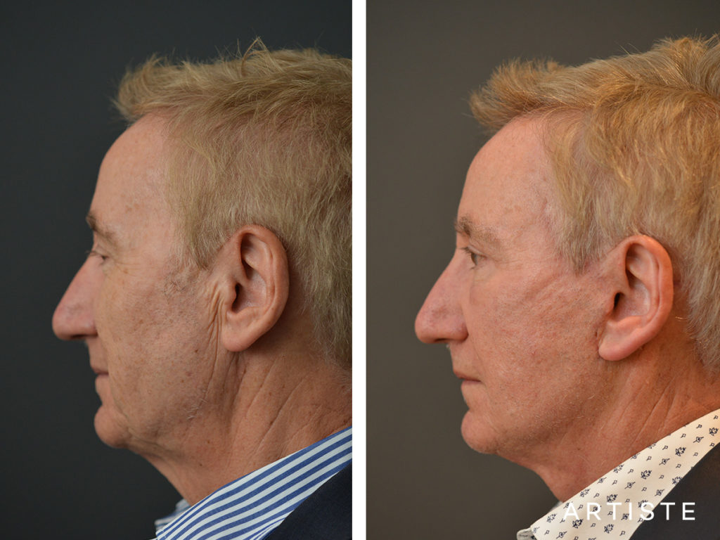 65 Years Old Face and Neck Lift