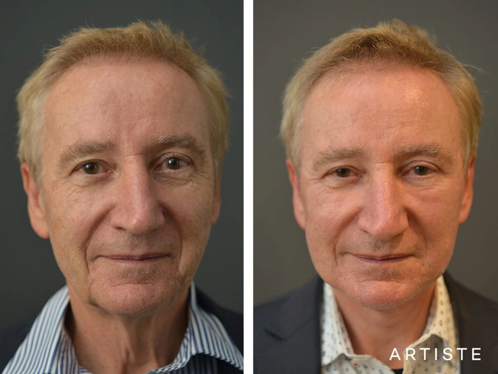 65 Years Old Face and Neck Lift: Artiste Deep Plane Face and Neck lift, Structutal Fat Grafting, Chemical Peel