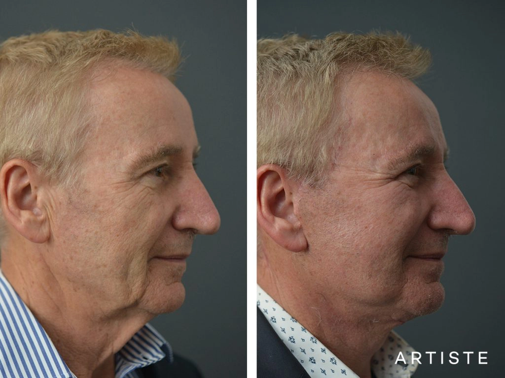 65 Years Old Face and Neck Lift: Artiste Deep Plane Face and Neck lift, Structutal Fat Grafting, Chemical Peel