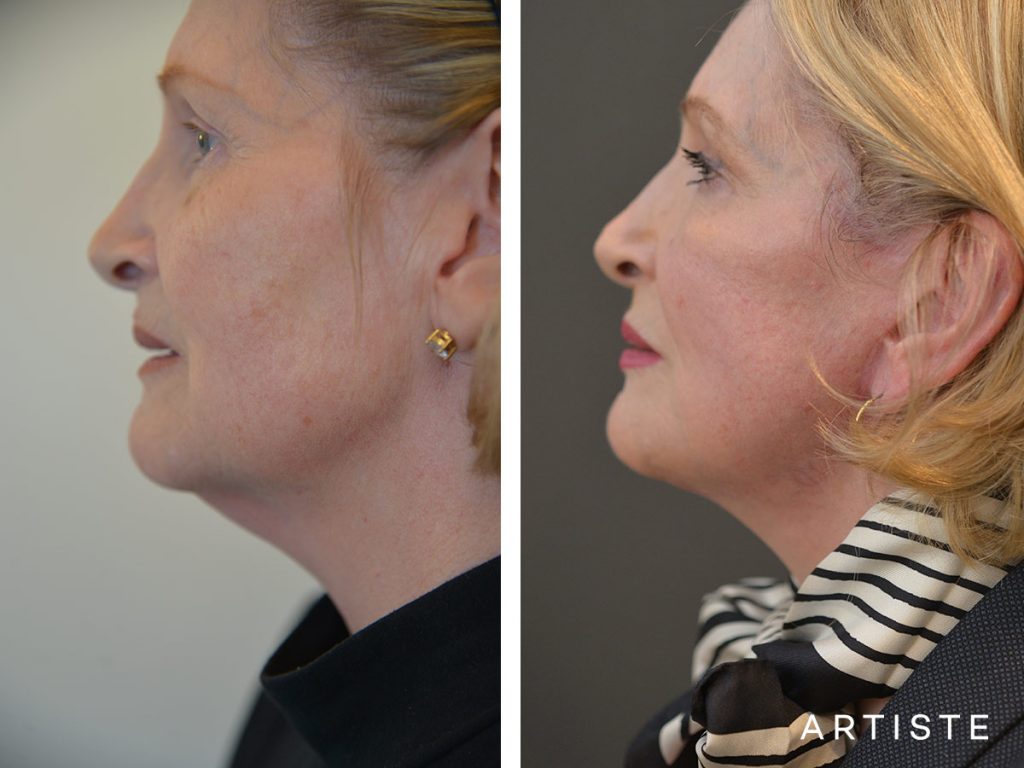 67 Year Old Signature Facelift