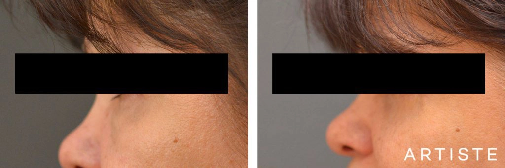 60 Year Old Lower Blepharoplasty