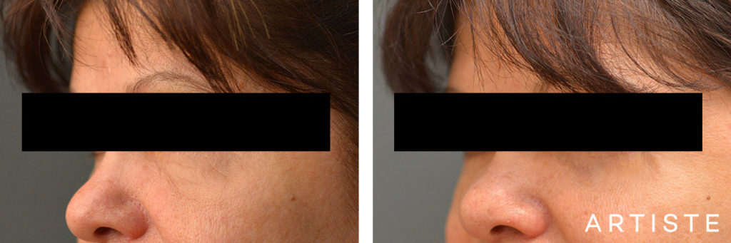 60 Year Old Lower Blepharoplasty