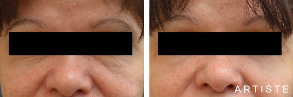 60 Year Old Lower Blepharoplasty