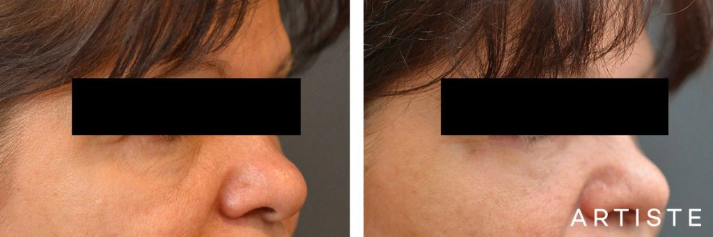 60 Year Old Lower Blepharoplasty