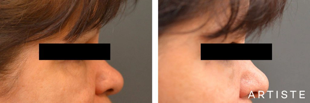 60 Year Old Lower Blepharoplasty