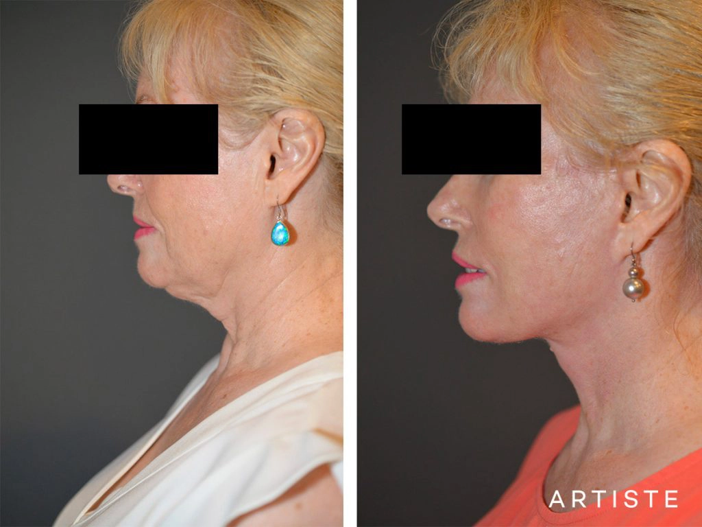 64 Year Old High SMAS Face and Neck Lift