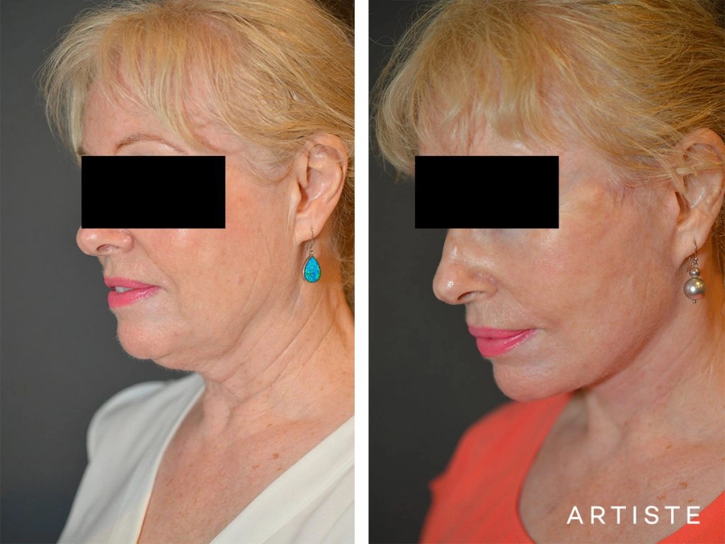 64 Year Old High SMAS Face and Neck Lift