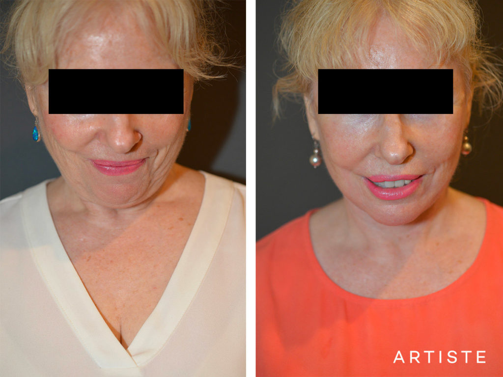 64 Year Old High SMAS Face and Neck Lift