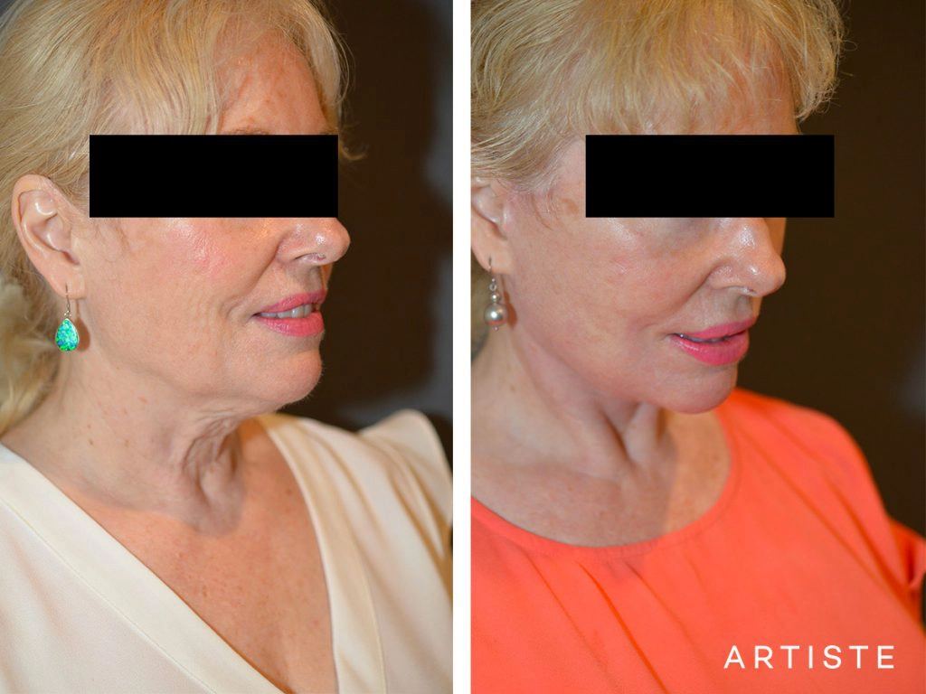 64 Year Old High SMAS Face and Neck Lift