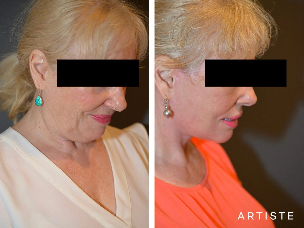 64 Year Old High SMAS Face and Neck Lift