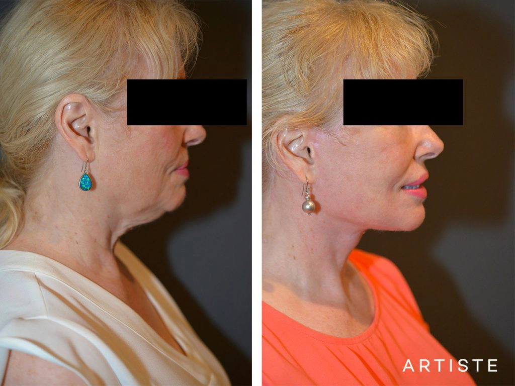 64 Year Old High SMAS Face and Neck Lift