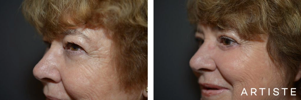 68 Year Old Upper + Lower Blepharoplasty