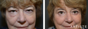 68 Year Old Upper + Lower Blepharoplasty