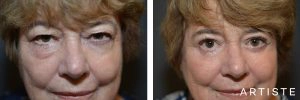 68 Year Old Upper + Lower Blepharoplasty