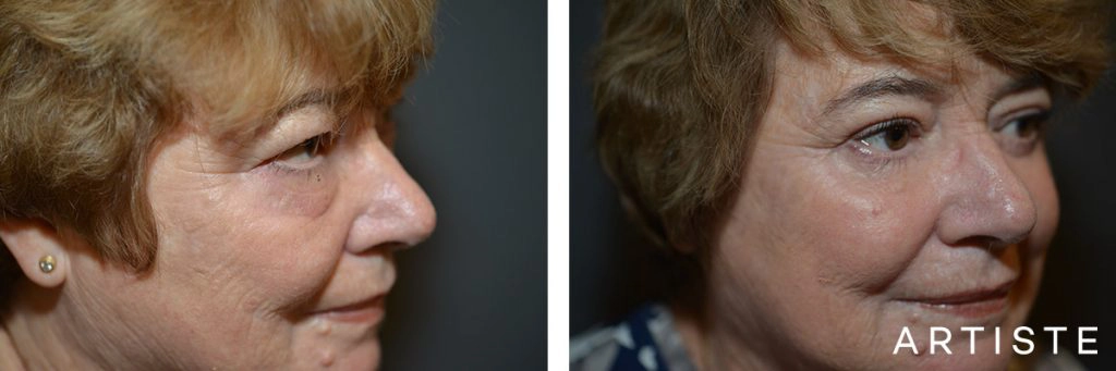 68 Year Old Upper + Lower Blepharoplasty