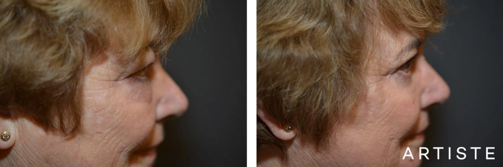 68 Year Old Upper + Lower Blepharoplasty