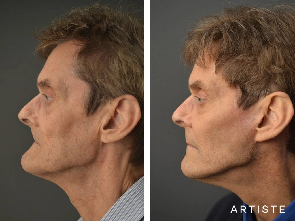 68 Years Old Male Facelift and Fat Grafting: Artiste Deep Plane Facelift, Stuctural Fat Grafting