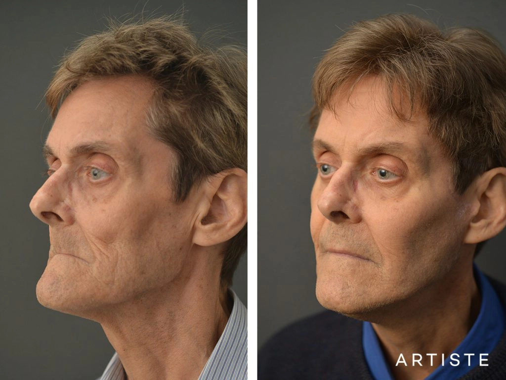 68 Years Old Male Facelift and Fat Grafting: Artiste Deep Plane Facelift, Stuctural Fat Grafting