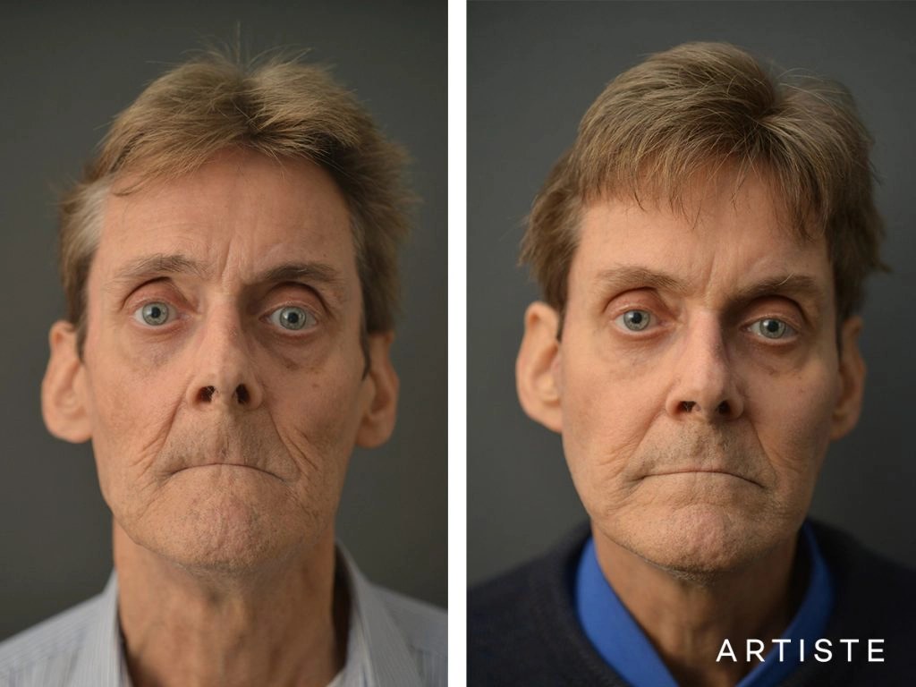 68 Years Old Male Facelift and Fat Grafting: Artiste Deep Plane Facelift, Stuctural Fat Grafting