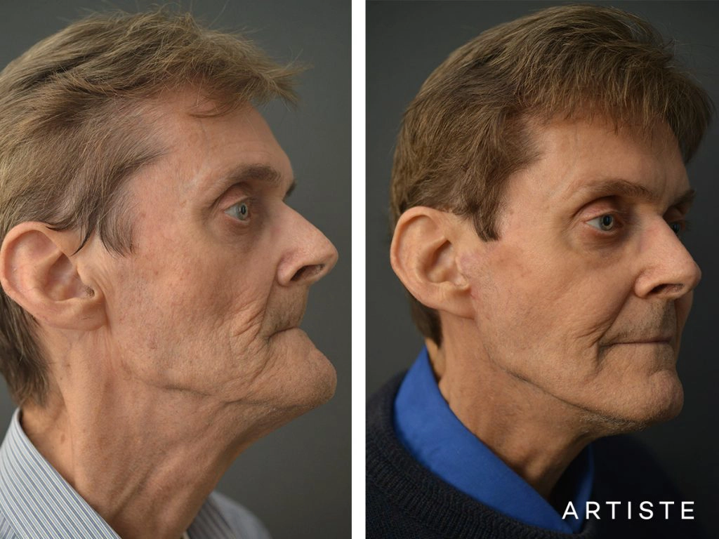 68 Years Old Male Facelift and Fat Grafting: Artiste Deep Plane Facelift, Stuctural Fat Grafting