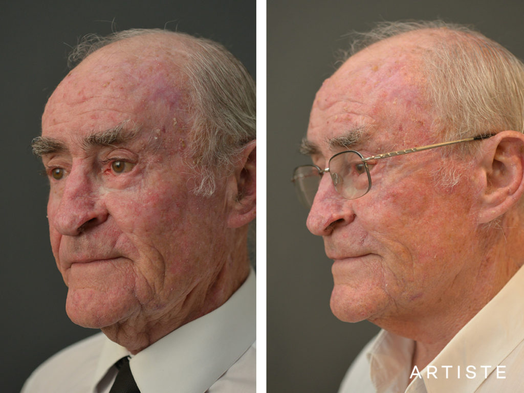 76 Years Old Male Facelift