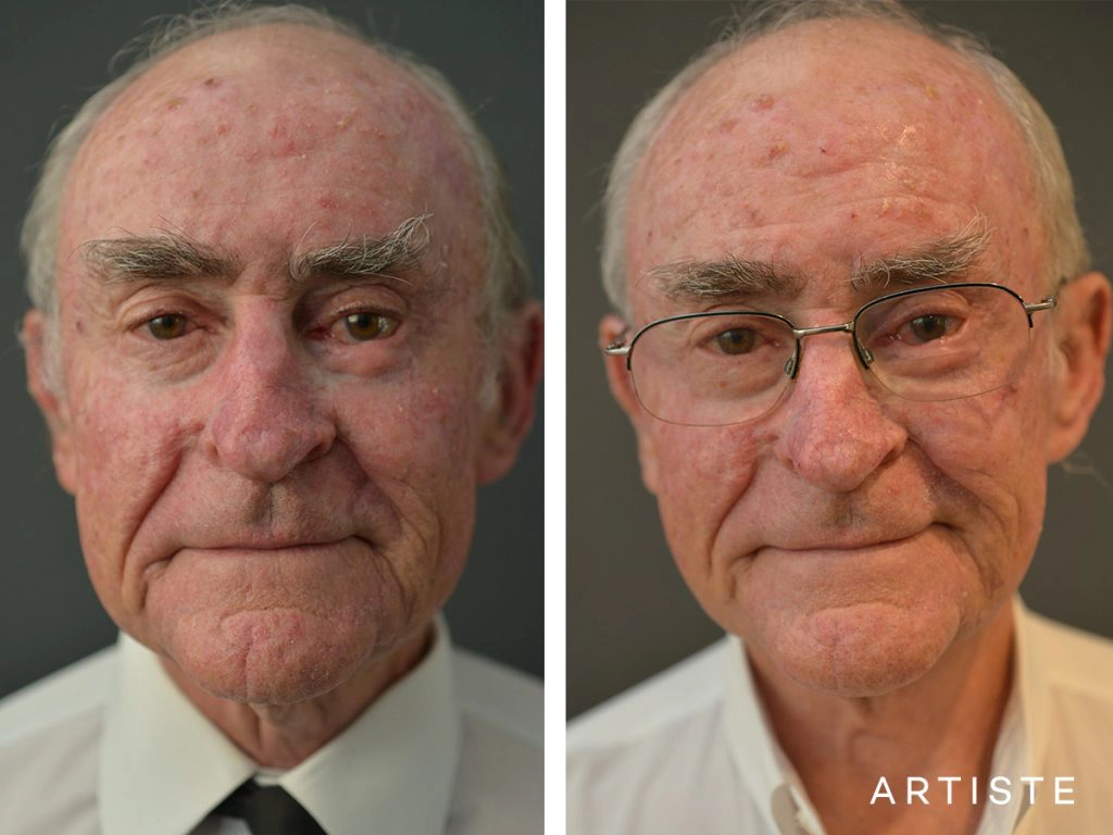 76 Years Old Male Facelift: Artiste Deep Plane Facelift