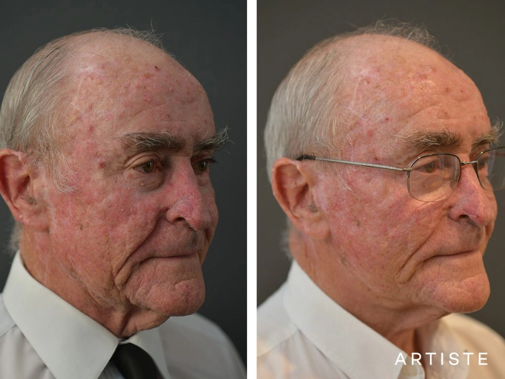 76 Years Old Male Facelift: Artiste Deep Plane Facelift