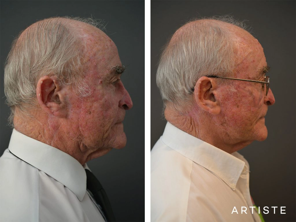 76 Years Old Male Facelift: Artiste Deep Plane Facelift