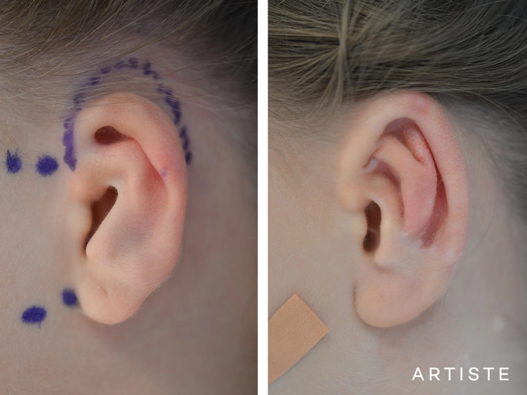 9 Year Old Ear Reconstruction Microtia