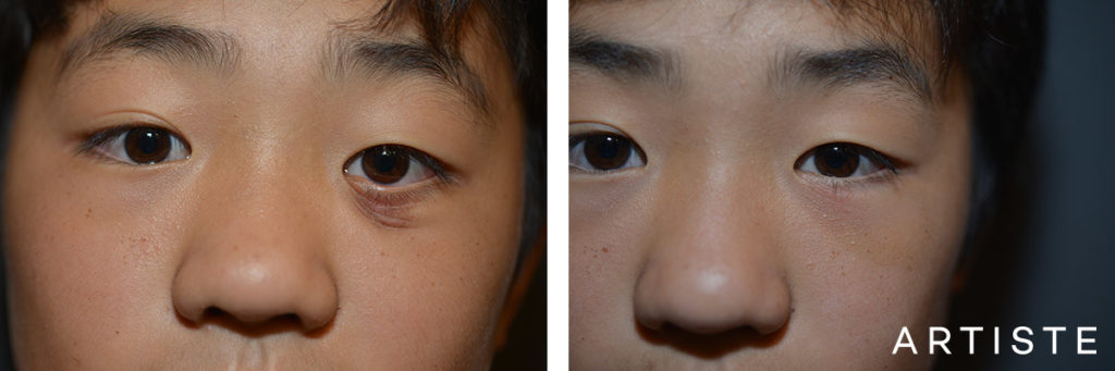 9 Year Old Male Eyelid Scar Revision