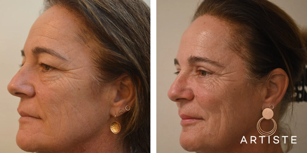 50 Year Old Upper Blepharoplasty