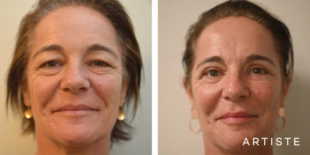 50 Year Old Upper Blepharoplasty