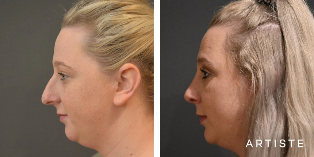 29 Year Old Profile Rhinoplasty