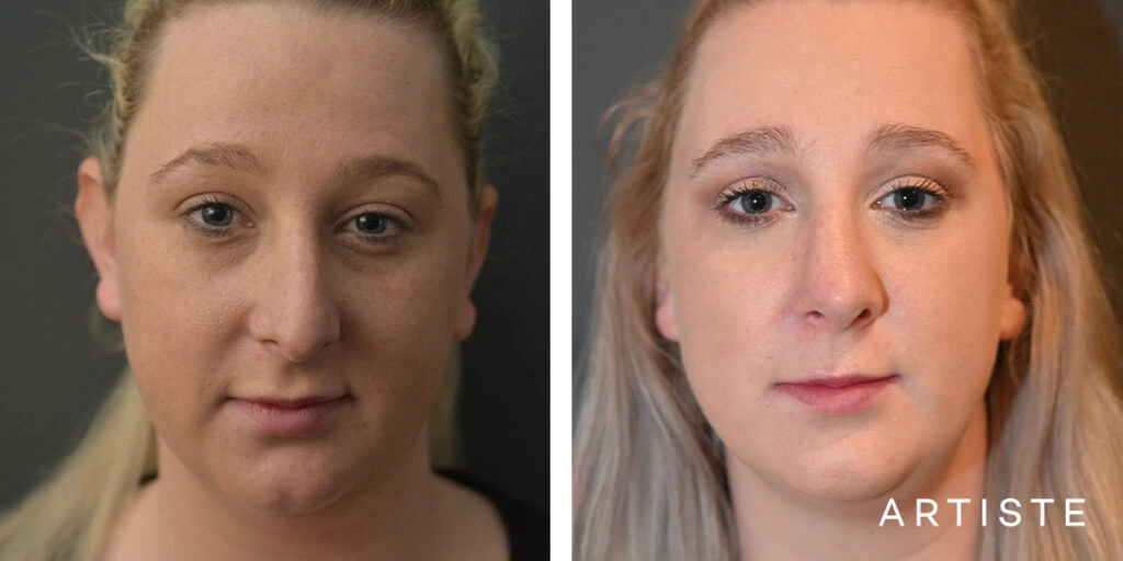 29 Year Old Profile Rhinoplasty