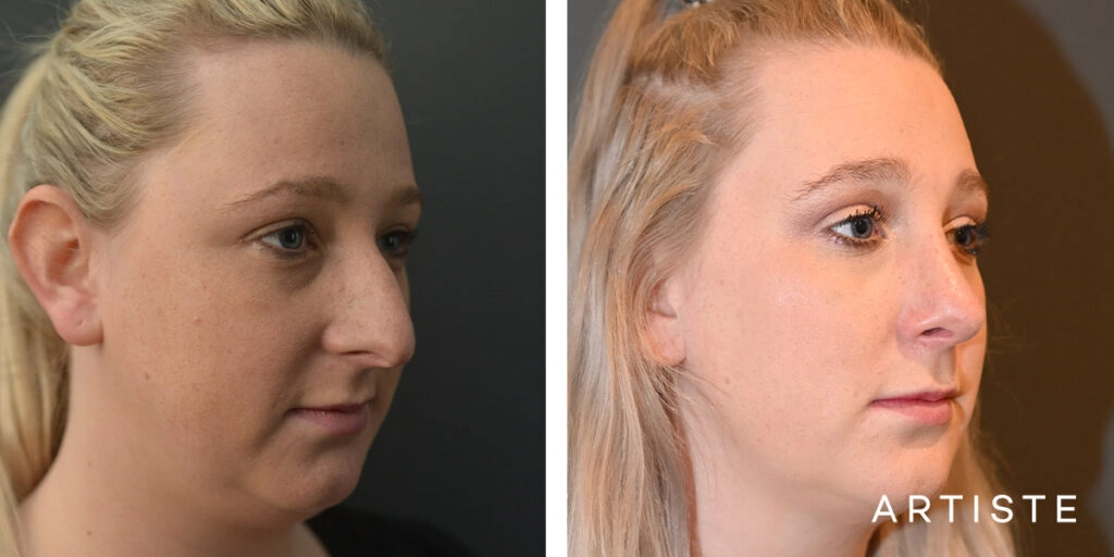 29 Year Old Profile Rhinoplasty