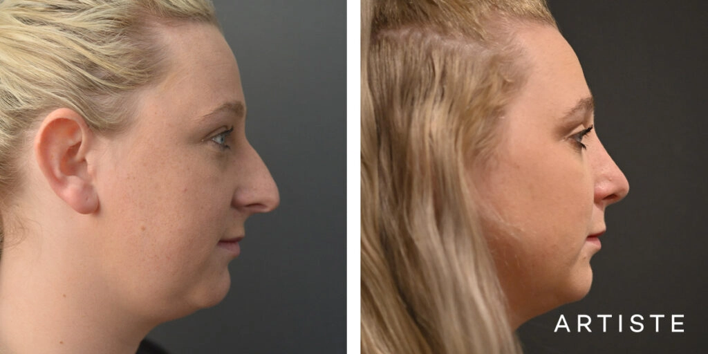 29 Year Old Profile Rhinoplasty