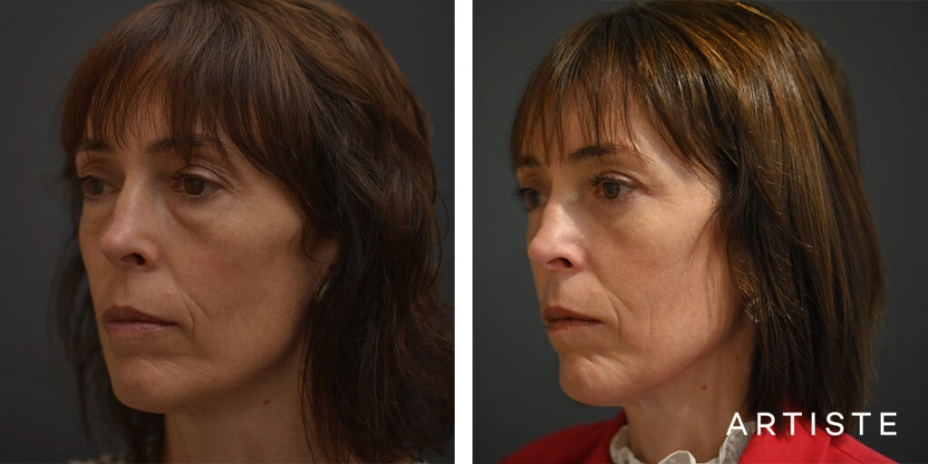 48 Year Old Lower Blepharoplasty