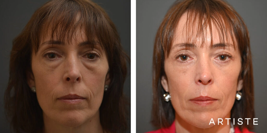 48 Year Old Lower Blepharoplasty