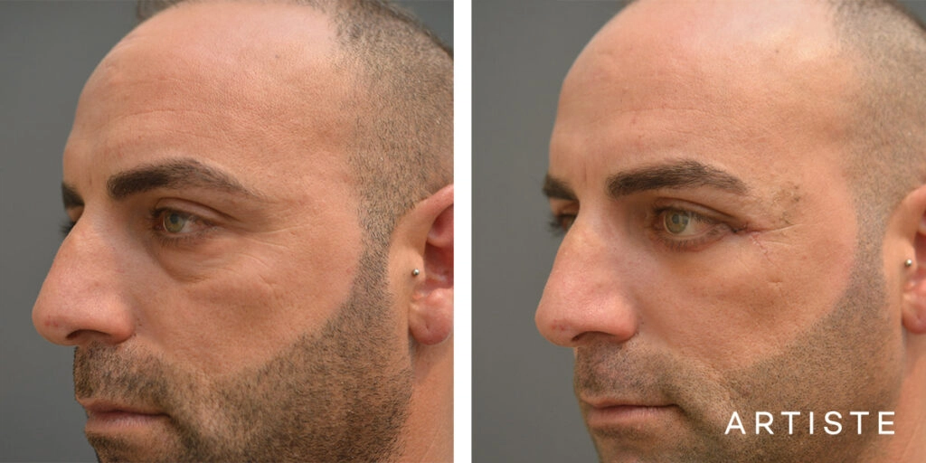 37 Year Old Lower Blepharoplasty (4 weeks)