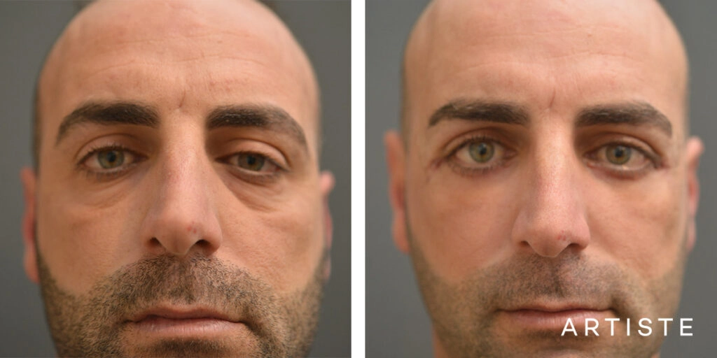 37 Year Old Lower Blepharoplasty (4 weeks)