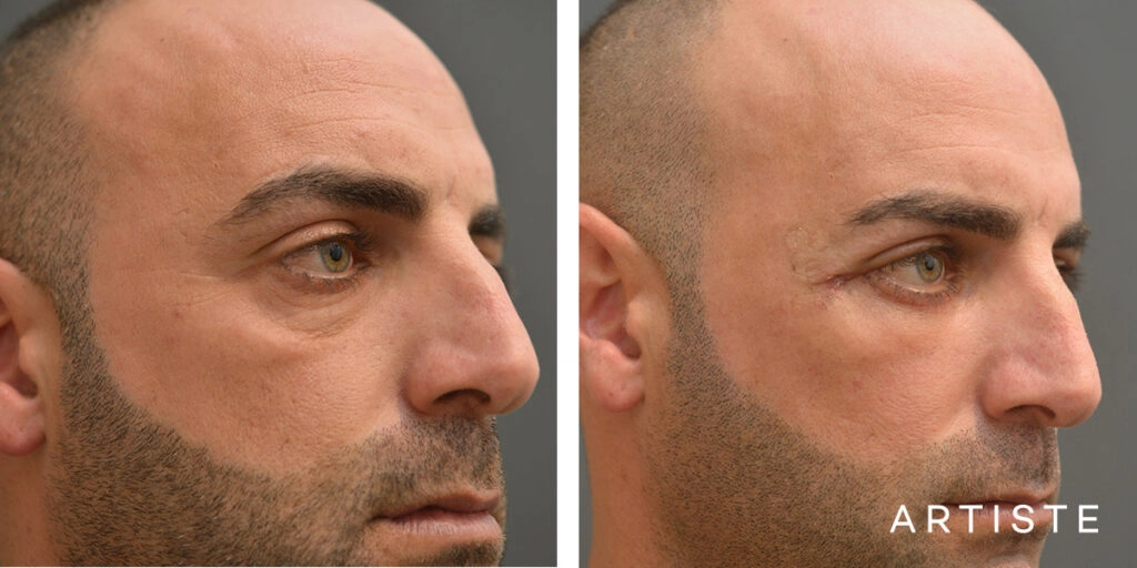 37 Year Old Lower Blepharoplasty (4 weeks)