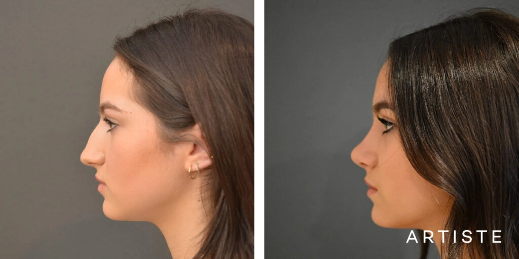 19 Year Old Profile Rhinoplasty