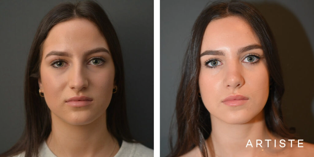 19 Year Old Profile Rhinoplasty