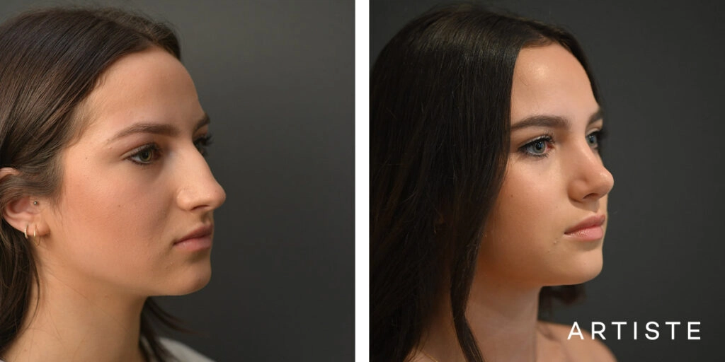 19 Year Old Profile Rhinoplasty