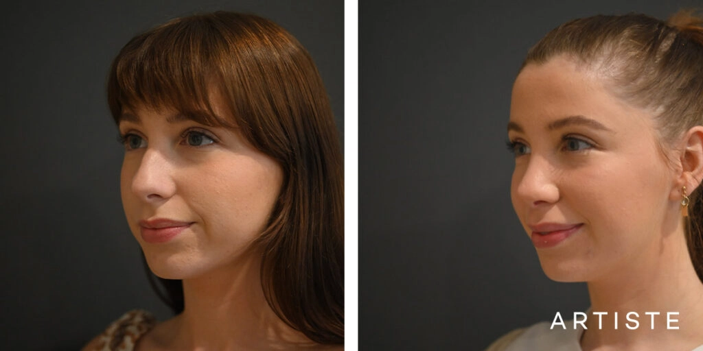 24 Year Old Female Total Nose Rhinoplasty