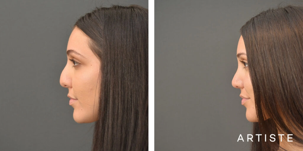 25 Year Old Shape (Dorsal Reduction) Rhinoplasty