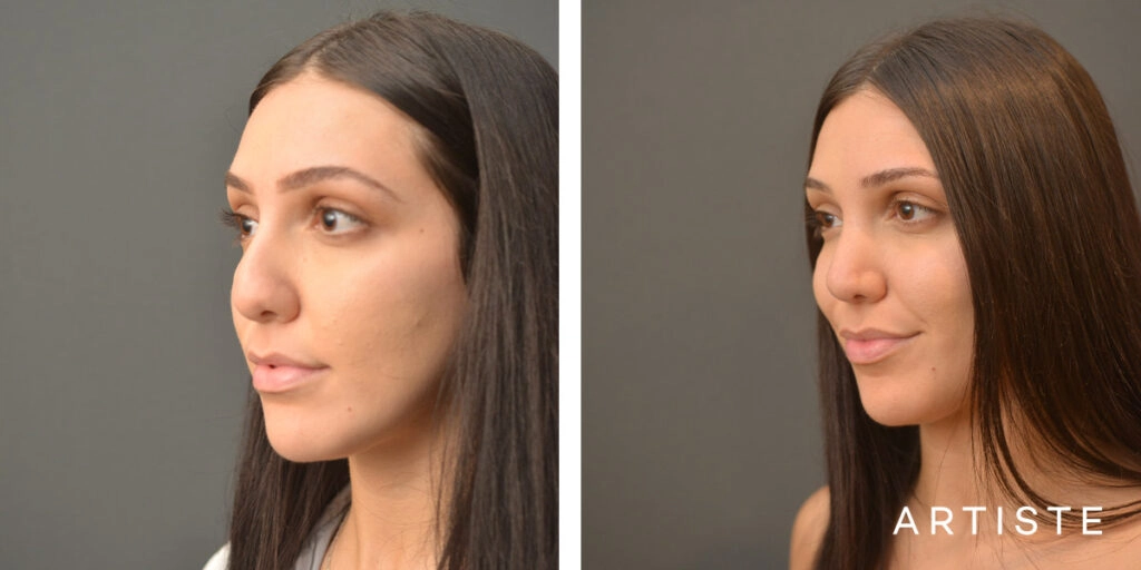 25 Year Old Shape (Dorsal Reduction) Rhinoplasty