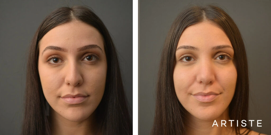 25 Year Old Shape (Dorsal Reduction) Rhinoplasty