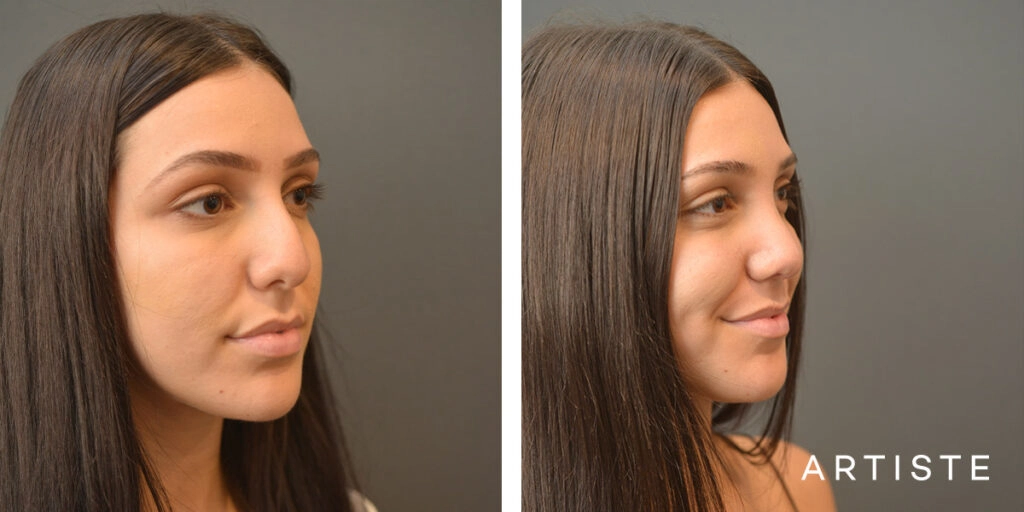 25 Year Old Shape (Dorsal Reduction) Rhinoplasty